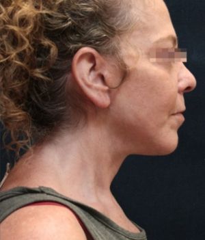 Facelift Before & After Patient #11659