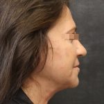 Facelift Before & After Patient #11660