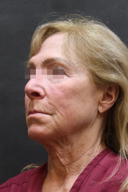 Facelift Before & After Patient #11662