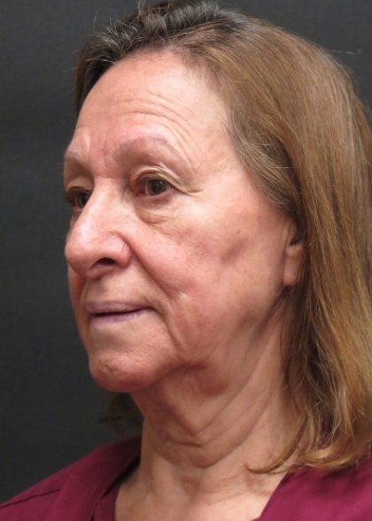 Levinelift Before & After Patient #11793