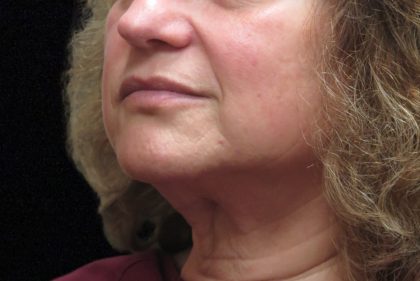 Levinelift Before & After Patient #11825