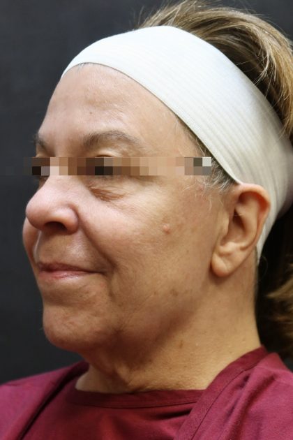 Levinelift Before & After Patient #11791