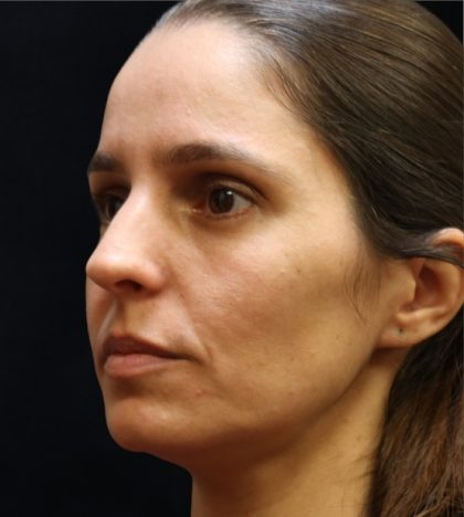 Rhinoplasty Before & After Patient #11947