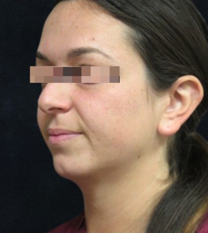 Rhinoplasty Before & After Patient #11948