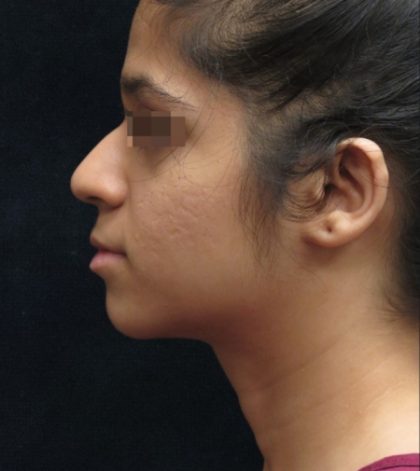 Rhinoplasty Before & After Patient #11949