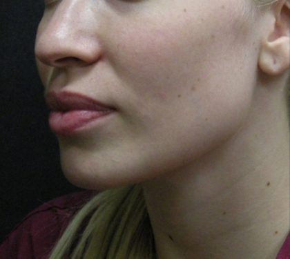 Rhinoplasty Before & After Patient #11950