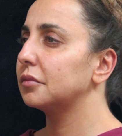 Rhinoplasty Before & After Patient #11951