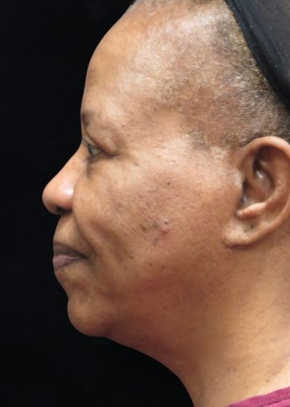 Rhinoplasty Before & After Patient #11952