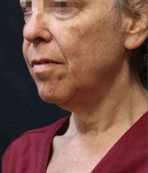Facelift Before & After Patient #11659