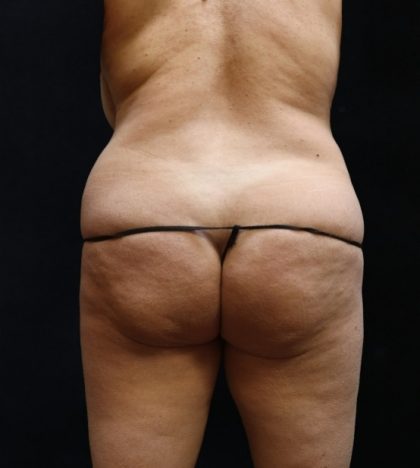 Liposuction Before & After Patient #11548