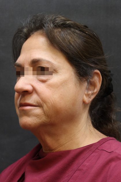 Facelift Before & After Patient #11660