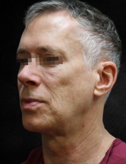 Facelift Before & After Patient #11661