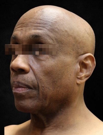 Facelift Before & After Patient #11665