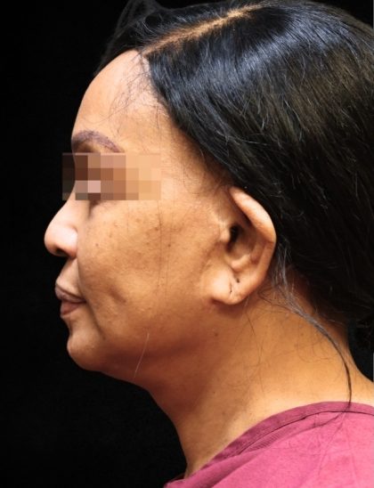 Facelift Before & After Patient #11668