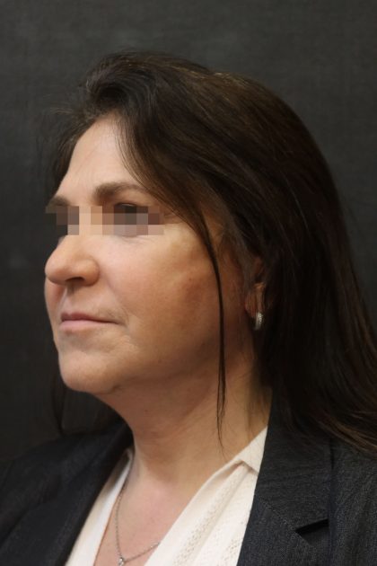 Facelift Before & After Patient #11660