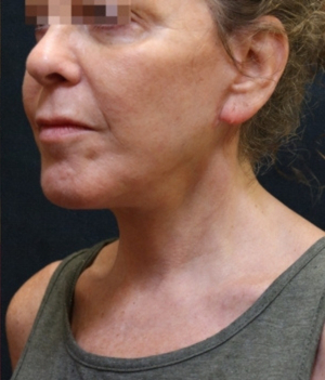 Levinelift Before & After Patient #11787