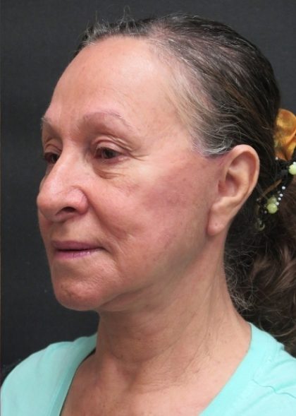 Levinelift Before & After Patient #11793