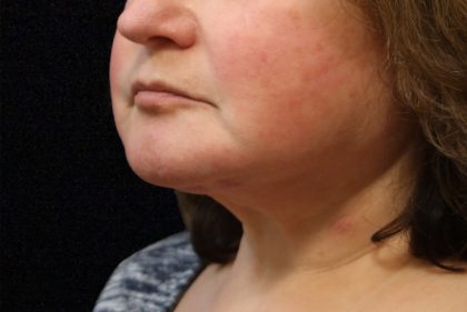 Levinelift Before & After Patient #11825