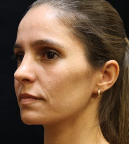 Rhinoplasty Before & After Patient #11947