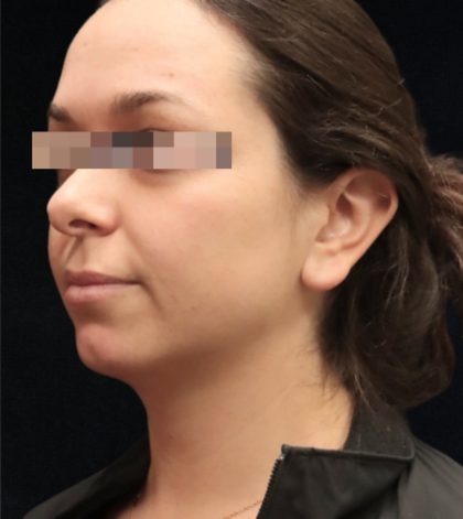 Rhinoplasty Before & After Patient #11948