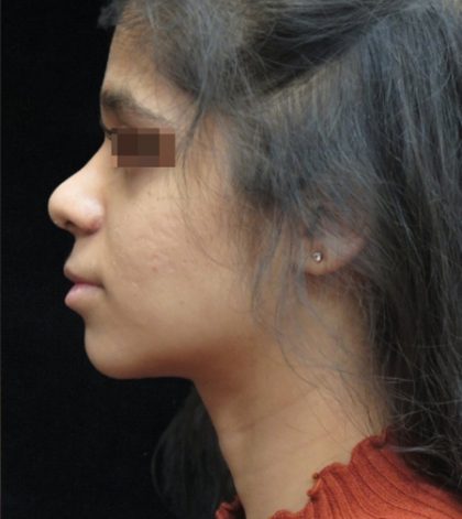 Rhinoplasty Before & After Patient #11949