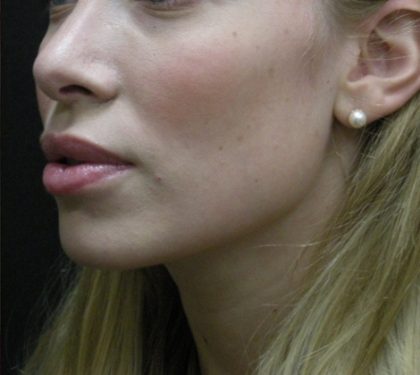 Rhinoplasty Before & After Patient #11950