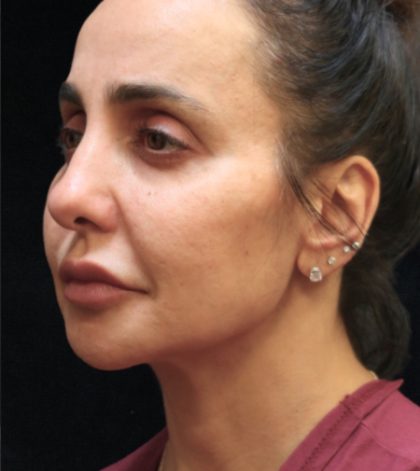Rhinoplasty Before & After Patient #11951