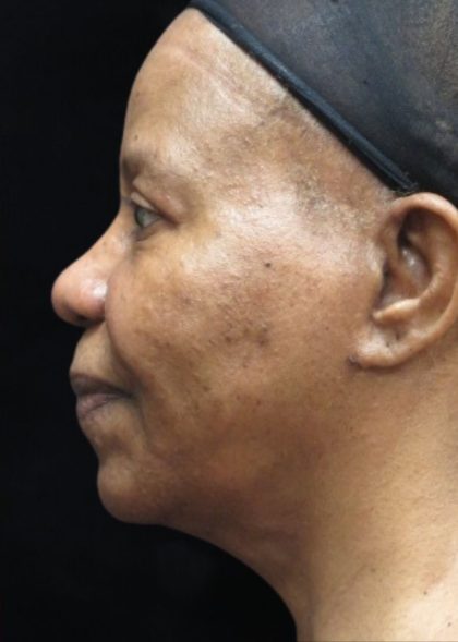 Rhinoplasty Before & After Patient #11952