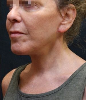 Facelift Before & After Patient #11659
