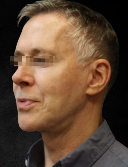 Facelift Before & After Patient #11661