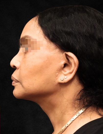 Facelift Before & After Patient #11668