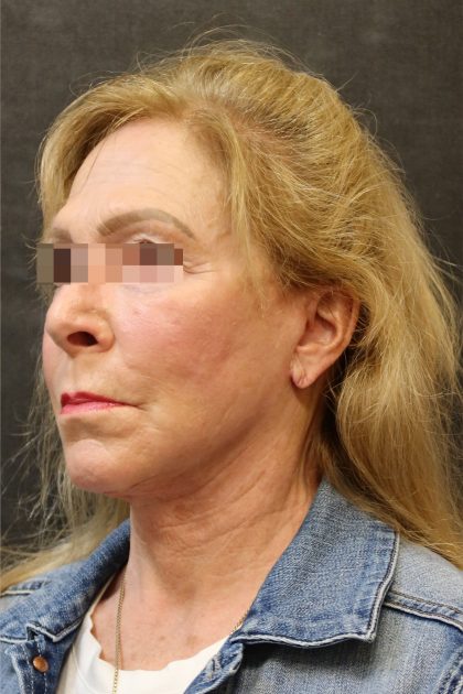 Facelift Before & After Patient #11662