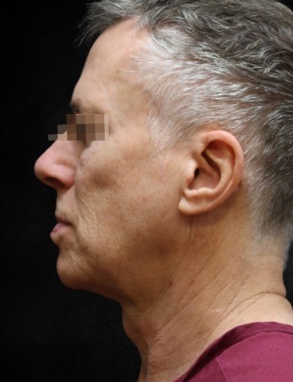Facelift Before & After Patient #11661