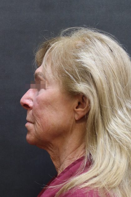 Levinelift Before & After Patient #11790