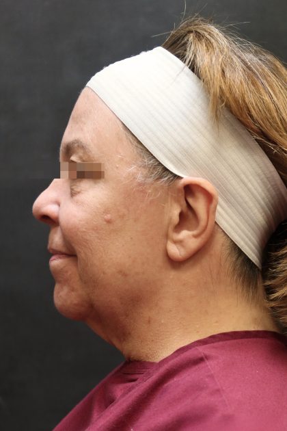 Levinelift Before & After Patient #11791