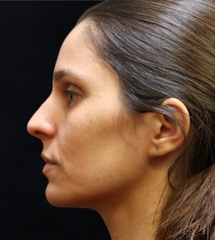 Rhinoplasty Before & After Patient #11947