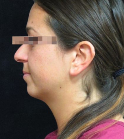 Rhinoplasty Before & After Patient #11948