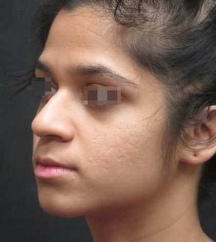 Rhinoplasty Before & After Patient #11949