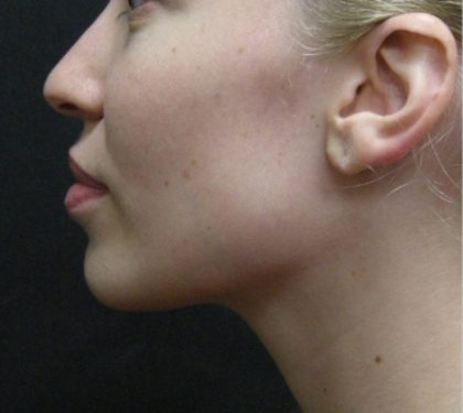 Rhinoplasty Before & After Patient #11950