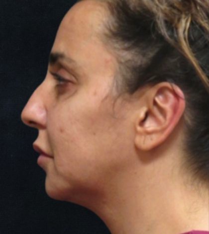 Rhinoplasty Before & After Patient #11951