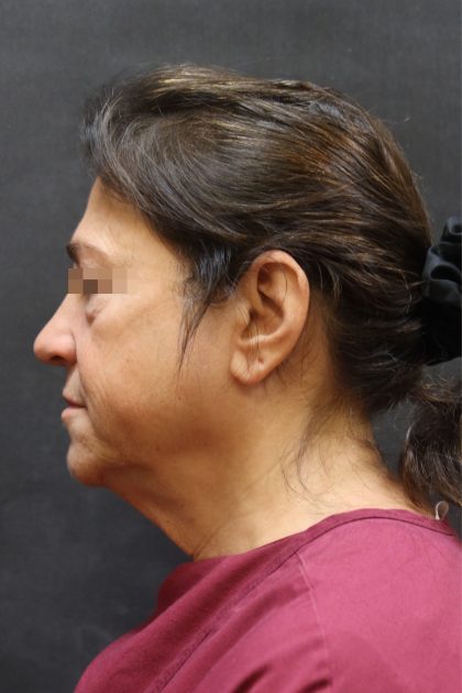 Facelift Before & After Patient #11660