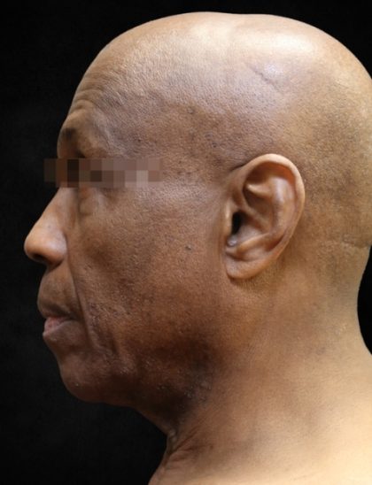 Facelift Before & After Patient #11665