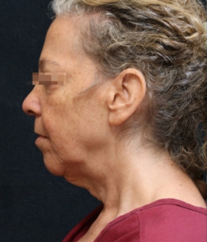 Levinelift Before & After Patient #11787