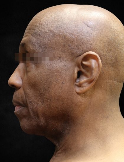 Levinelift Before & After Patient #11792