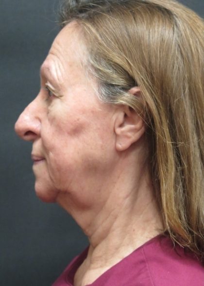 Levinelift Before & After Patient #11793