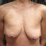 Breast Augmentation Before & After Patient #11504