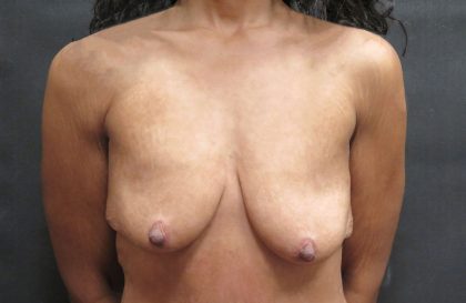 Breast Augmentation Before & After Patient #11504