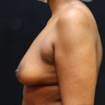 Breast Augmentation Before & After Patient #11505