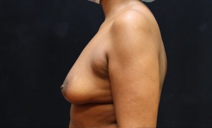 Breast Augmentation Before & After Patient #11505