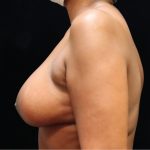 Breast Augmentation Before & After Patient #11505